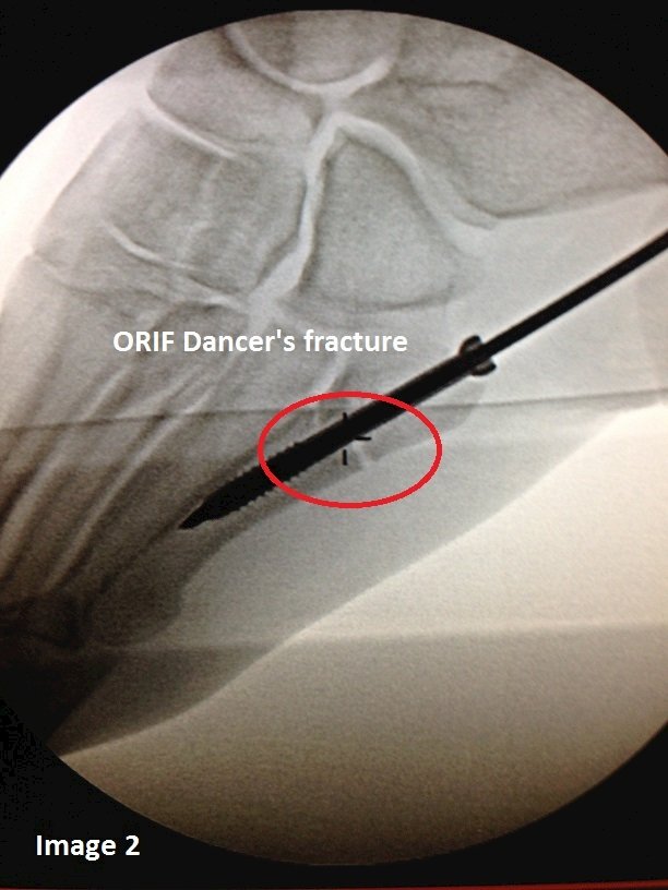 ORIF dancer's fracture